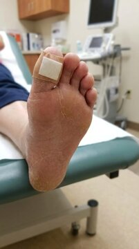 Endocrine limb pathology: diabetic foot, adhesive bandage, dermal lesion, calcaneus hyperkeratosis, clinical examination, injury management, podiatry therapy, sole assessment.