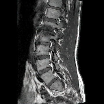 Sagittal T1-Weighted MRI of the Lumbar Spine Showing Multilevel Degenerative Disc Disease, Disc Protrusions and Foraminal Stenosis