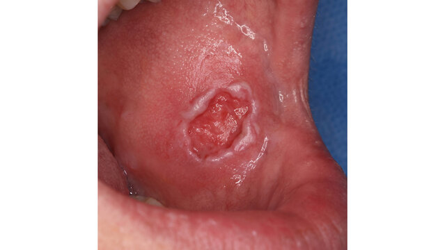 Cheek mucosa displaying a painful aphthous ulcer with a raw red center and distinct white borders is photographed closely.