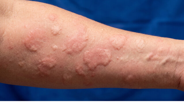 Forearm of an individual displaying severe urticaria with large raised pink welts and skin inflammation.