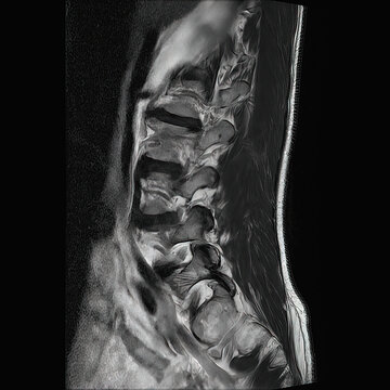 Sagittal T2-Weighted MRI of the Lumbar Spine Showing Multilevel Degenerative Disc Disease, Disc Protrusions and Neural Foraminal Stenosis