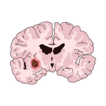 Brain Tumor Cross Section Anatomy Vector Illustration