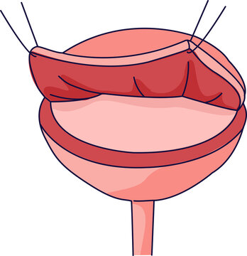 Partial Cystectomy Bladder Opening Surgical Vector Illustration