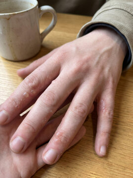 Dyshidrotic Eczema with Small Blisters on Fingers Close Up