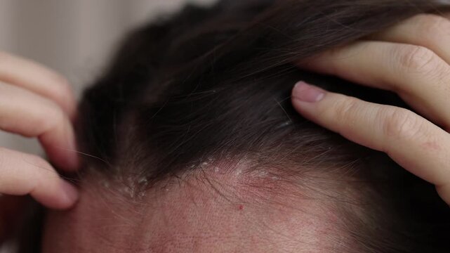 Woman scratching scalp because of dermatitis and dandruff. 4K, slow motion.