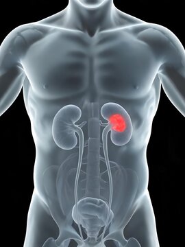 Renal Cell Carcinoma 3D medical illustration displaying malignant tumor lesion within human kidney anatomy