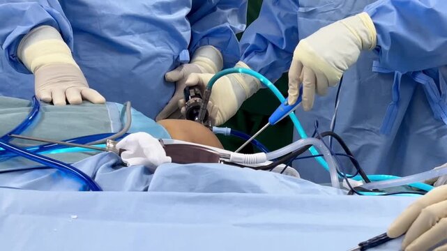 A team of doctor or surgeon did surgery inside operating room in hospital.People holding medical equipment or surgical tool in keyhole endoscopic surgery.Minimal invasive joint arthroscopic procedure.