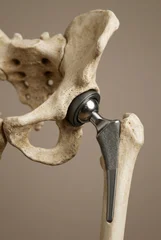 Human pelvis and femur bone fitted with a metallic total hip replacement implant. Detailed medical illustration of joint replacement surgery and titanium prosthesis on beige background. Generative AI. © juanorihuela