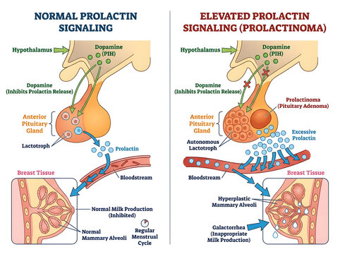 Normal vs elevated prolactin signaling in mammary gland isolated on white background