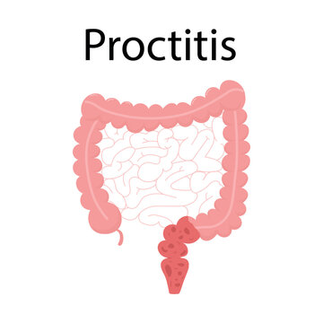 Proctitis medical illustration showing inflammation of rectum and colon with anatomical diagram on clean background for healthcare education