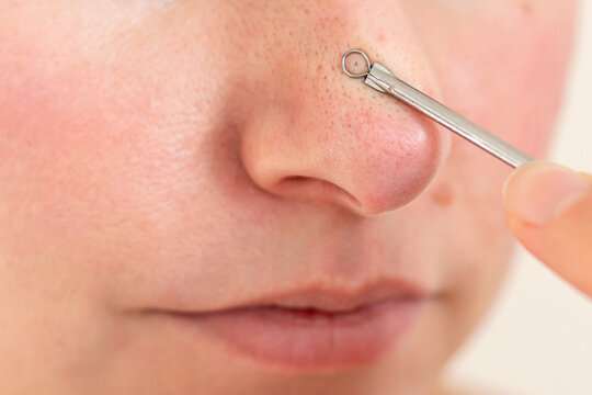 Close-up young Caucasian woman squeezing out black dots, blackheads on her nose with a special tool. Cleansing the pores of impurities. Cosmetology and dermatology. Acne and pimples