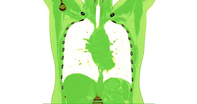 Coronal chest CT scan rendered in vivid green false color zooms through the thorax revealing bronchogenic pneumonia.