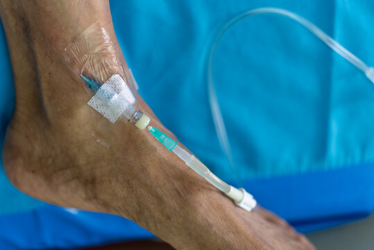 Intravenous IV cannula secured to patient arm medical tape tubing for fluid or medication delivery during hospital treatment clinical care