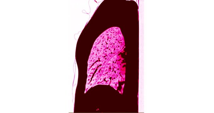 A grid of red toned sagittal CT scan slices compares multiple chest views revealing bronchogenic pneumonia.
