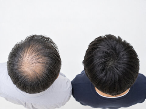 大人二人の頭頂部を真上から並べて比べた様子