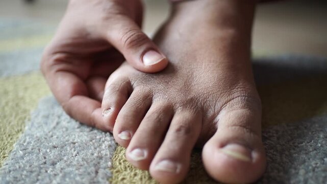 Close up of person touching itchy toe with dry skin, slow motion close up foot discomfort
