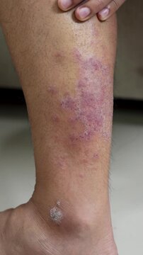Men experience itchy legs due to germs and bacteria.