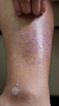 Men experience itchy legs due to germs and bacteria.