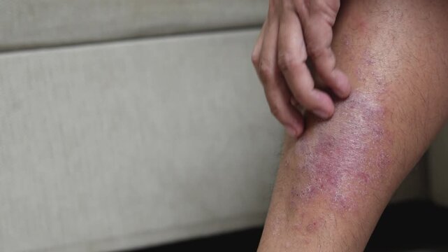 Men experience itchy legs due to germs and bacteria.