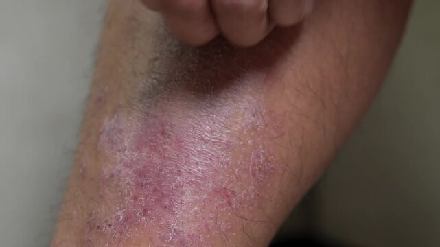 Men experience itchy legs due to germs and bacteria.