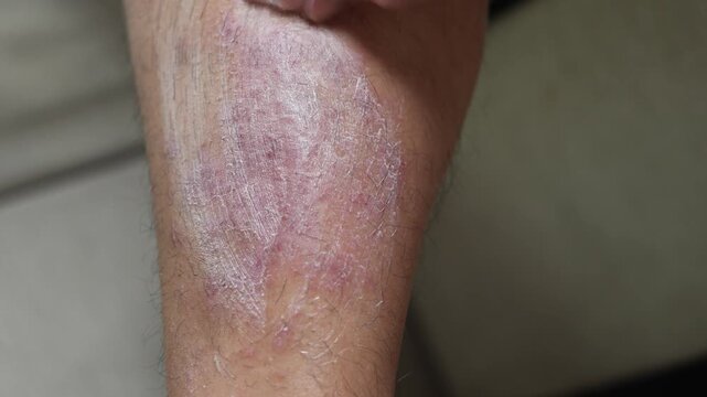 Men experience itchy legs due to germs and bacteria.