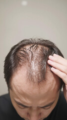 Fototapeta premium Japanese Young man deeply depressed by advanced male pattern baldness and scalp exposure, Copy space on the top, Aerial view, Vertical image