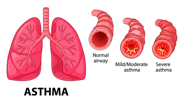 Illustration of healthy and asthmatic lungs showing bronchial constriction