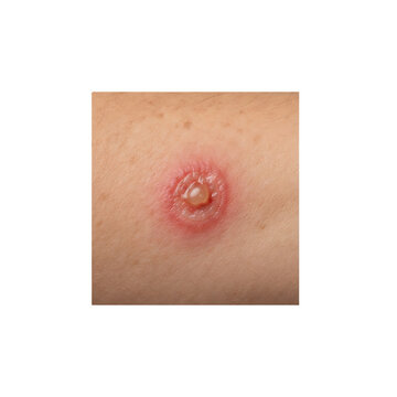 Close-up of a skin lesion with inflammation and redness on human body