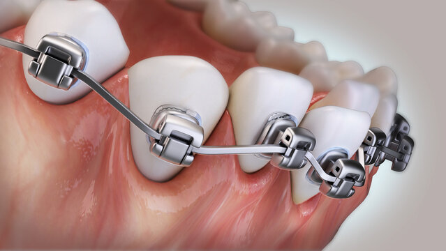 Self-ligating orthodontic braces &mdash; Medically accurate 3D rendering