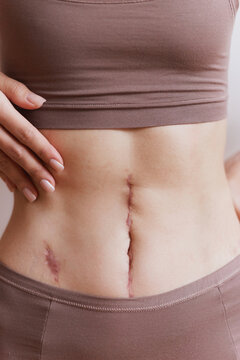 Anonymous Woman Touching Abdomen with Scar