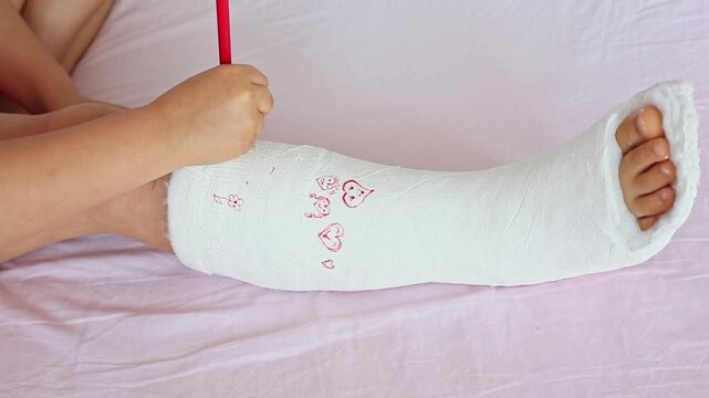 A unrecognizable little girl with a broken leg at home on the bed draws with felt-tip pens on an orthopedic cast . How to have fun with a broken leg. Broken leg in a cast of an young child. 