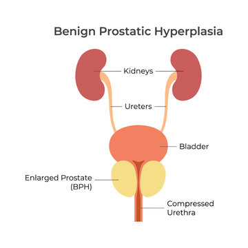 Benign Prostatic Hyperplasia Anatomy Diagram Showing Enlarged Prostate and Compressed Urethra