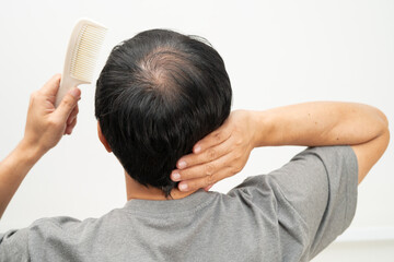 Fototapeta premium Bald in the middle head and begin no loss hair glabrous of mature Asian business smart active office man.