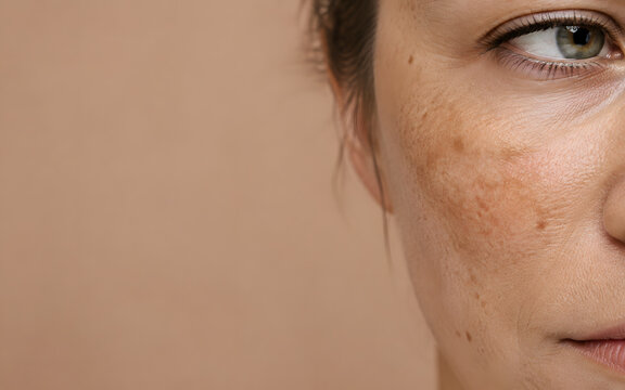 Facial Freckles and Sun Spots Pigmentation on Female Cheek with Copy Space Background
