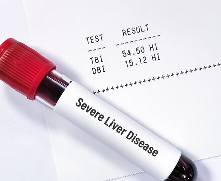 Abnormal report of Bilirubil (total and Direct), May be due to sever liver damage icluding Bile Duct Blockages, Post-Hepatic Obstruction, Dubin-Johnson syndrome, Rotor syndrome etc.