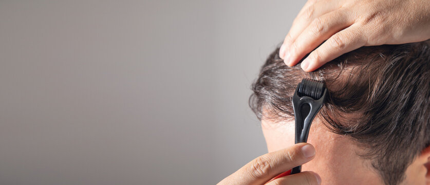 Man applying a derma roller. Stimulate hair growth