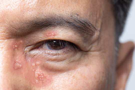 Shingles, Zoster or Herpes Zoster symptoms on face and eyeis a medical emergency.