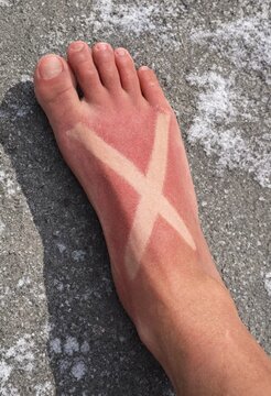 Sunburned foot with an X shaped tan line from strappy sandals on a hot summer day