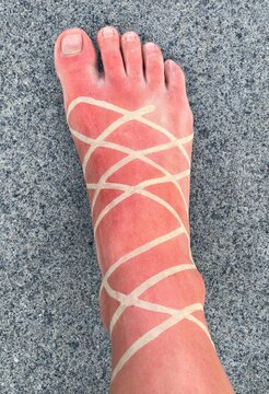 A severe sunburn on a human foot with distinct tan lines from sandal straps