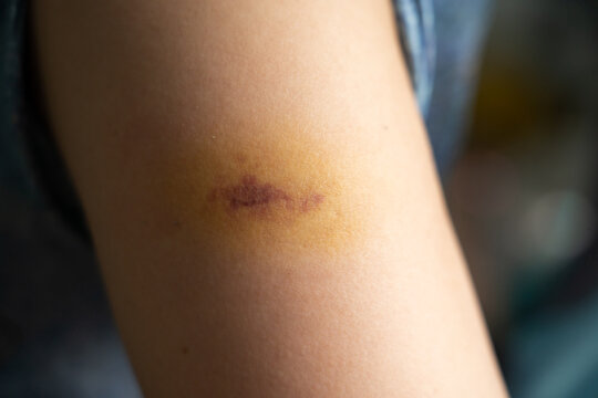 Bruise injury found on the female arm