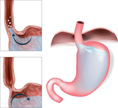 Gastroesophageal Reflux Disease GERD and Acid Reflux Medical Illustration. GERD Mechanism with Stomach Acid Flow and Lower Esophageal Sphincter Illustration