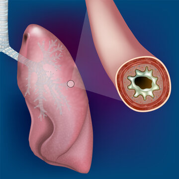 Bronchitis in Human Lung with Inflamed Bronchus and Airway Cross Section Illustration. Bronchial Inflammation and Mucus in Lung Airway Medical Illustration of Bronchitis