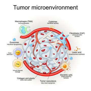 Tumor microenvironment TME. Cellular diagram cancer cells, CAFs, TAMs, angiogenesis, and immunosuppressive stroma.