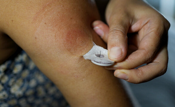 Woman Removing Continuous Glucose Monitor CGM Sensor from Arm
