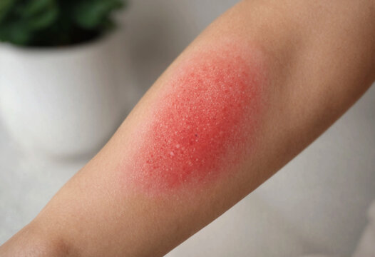 Close up of red skin rash on human forearm with irritation