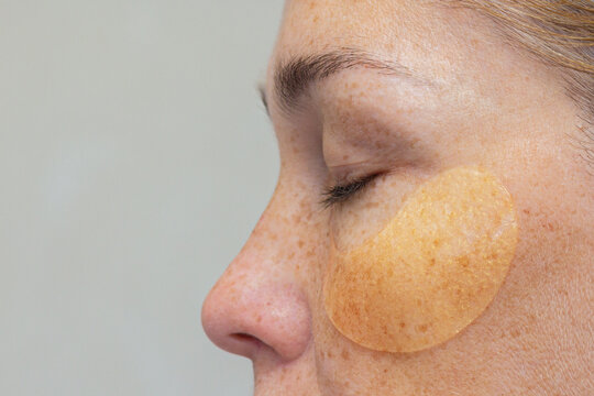 Woman s Profile with a Hydrogel Eye Patch Highlighting Freckled Skin