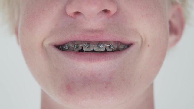Close-up of a smiling teenager wearing metal dental braces. Orthodontic treatment, teeth alignment and dental care concept