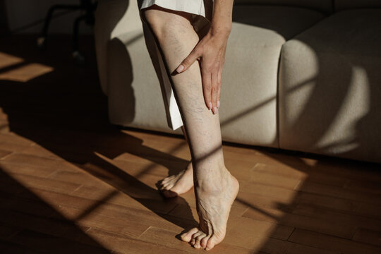 Varicose Veins Visible on Woman Touching Lower Leg at Home