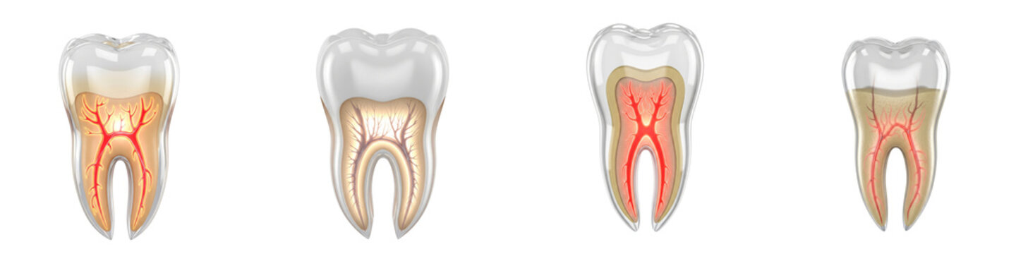 Set of four human teeth showing tooth nerve inflammation and decay