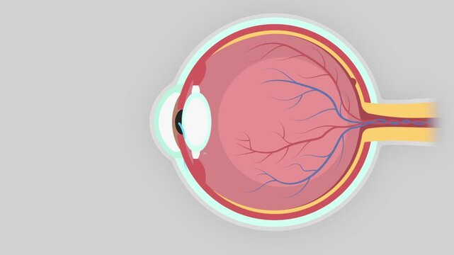 Animation showing the eye disease glaucoma develops with intraocular pressure